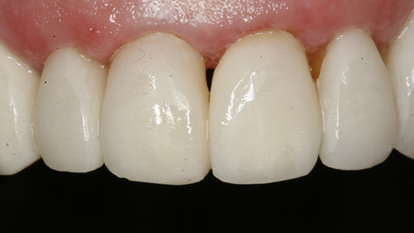 After Veneers in Twickenham