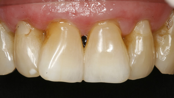 Before Veneers in Twickenham