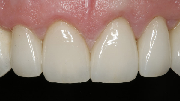 After Dental Veneers in Twickenham