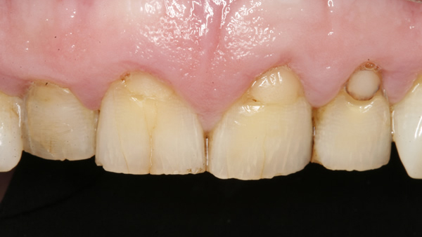 Before Dental Veneers in Twickenham