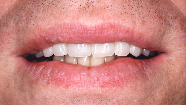 After Veneer Treatment in Twickenham