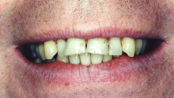 Before Veneer Treatment in Twickenham