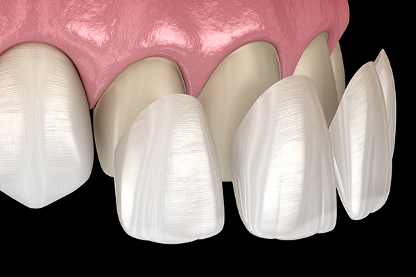 Dental Veneers