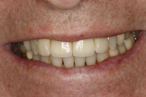 After Dental Implants Twickenham