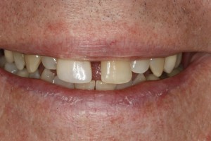 Before Dental Implants Twickenham