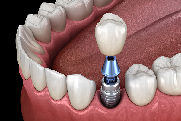 Dental Implants Twickenham