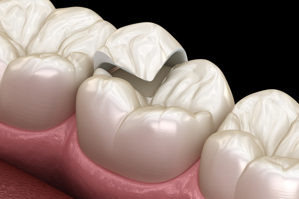 illustration-of-dental-onlay