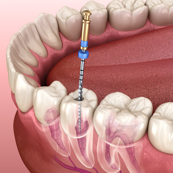 illustration-of-root-canal-treatment