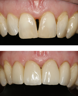 Dental Veneers case study in Twickenham