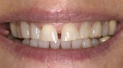 Before cosmetic bonding Twickenham