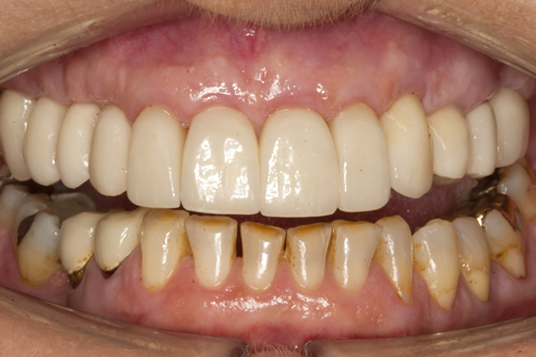 Twickenham dental implants