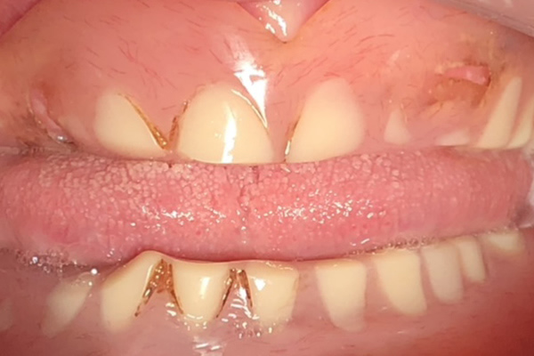 30year old worn out dentures